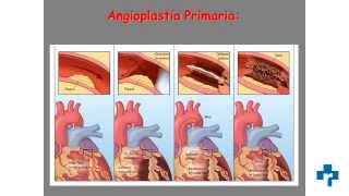 Cateterismo cardiaco y angioplastia coronaria técnicas que salvan vidas [upl. by Wolenik]