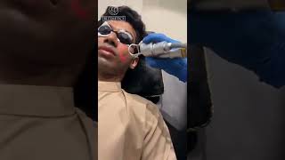 CO2 Fractional Laser StepbyStep  CO2 Fractional Laser Treatment  CO2 Fractional Laser [upl. by Swirsky]