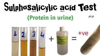 Sulphosalicylic acid test for albumin in urine [upl. by Atalya]