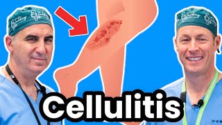 Cellulitis Explained By Infectious Disease Doc Red Sore And Swollen [upl. by Sukin]