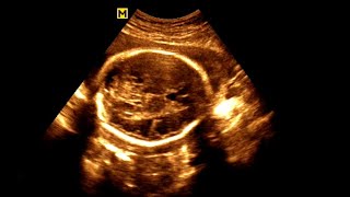 Routine antenatal ultrasound at 28 weeks gestation Ultrasonography of a 28week pregnancy [upl. by Notsruht824]