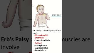 ErbDuchenne Palsy Insights into Upper Trunk Injuries of brachial plexus brachialplexusinjury [upl. by Walke577]