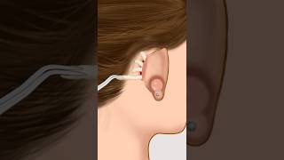 SAMR infected piercing removal animation p1animationsamr TheAnimatedCreated415viralshort [upl. by Noyr]