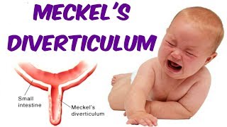 Meckels Diverticulum [upl. by Onstad]