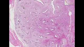 Histopathology Breast Fibroadenoma [upl. by Oicelem664]