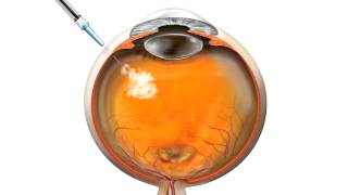 Anti VEGF Injection for macular degeneration [upl. by Obbard]