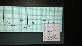 Myocardial ischemia ECG class [upl. by Cown]