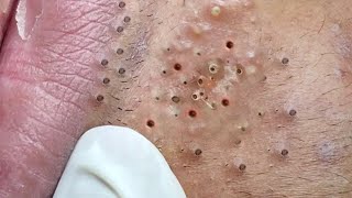 Big Cystic Acne Blackheads Extraction Blackheads amp Milia Whiteheads Removal Pimple Popping  1355 [upl. by Jehiah]