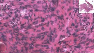 Meningioma  Histopathology [upl. by Rehtnug]