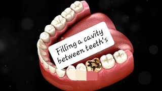 How to Fill Cavities StepbyStep Guide  Dental Care  Motivational Video [upl. by Marion]