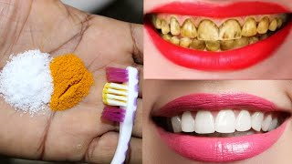 How Did I Whiten My Teeth at Home in 3 days Teeth Whitening Tips [upl. by Sorac]