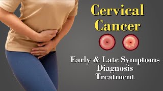 Cervical Cancer  HPV  Causes  Symptoms  Staging amp Treatment [upl. by Girish]