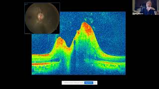 OCT in Neuro ophthalmic Disorders [upl. by Steffi]