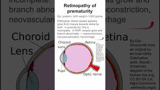 Retinopathy of prematurity [upl. by Ballou]