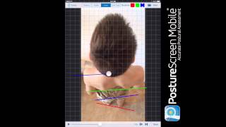 Axial Posture Assessment with PostureScreen App [upl. by Munafo]