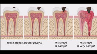 Stages of Tooth Decay Introduction [upl. by Adelice]