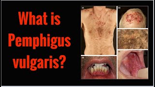 What is PEMPHIGUS VULGARIS Symptoms Causes [upl. by Rosy]