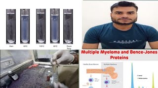 BenceJones protein test in hindi Multiplemayloma urine multiplmyloma [upl. by Monroy]