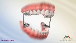 Orthodontic Treatment for Overjet Overbite  AdvanceSync Appliance [upl. by Sedgewake]