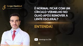 É Normal Ficar com um Círculo Vermelho no Olho Após Remover a Lente Escleral Entenda [upl. by Jurdi]