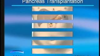 Pancreas Transplantation [upl. by Paulie]