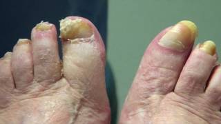 Can long toenails cause pain This patient takes her own video  long toenail cutting [upl. by Anirav773]