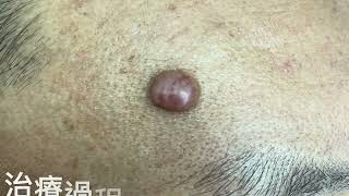 頭皮纖維瘤腫瘤切除 美麗新城診所莊禮謙醫師 Forehead Fibrom Dr George [upl. by Trace]