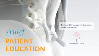 Mild Procedure Patient Education  Minimally Invasive Stenosis Treatment [upl. by Eintruok806]