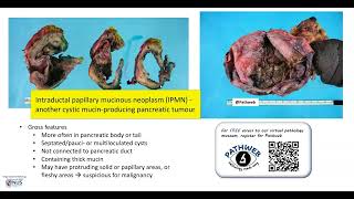 Pancreas Mucinous cystic neoplasm Gross pathology [upl. by Schmidt]