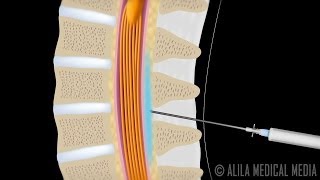 Lumbar Epidural Steroid Injection Animation [upl. by Gabbert]