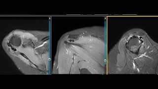 Calcific tendinitis of shoulder [upl. by Angelina]