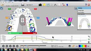 Adjusting Center of Force with TScan [upl. by Sher]