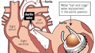 Pyrolytic Carbon Heart Valves  Graphene MCV [upl. by Ermin]