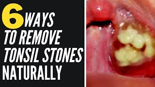 Remove Tonsil Stones Without Surgery with 4 Easy Ways [upl. by Charlton]