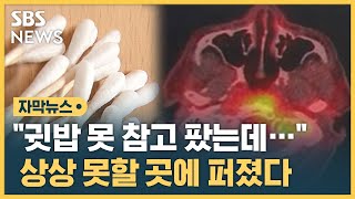 quot귓밥 못 참고 팠는데…quot 상상 못할 곳에 퍼졌다 자막뉴스  SBS [upl. by Lambert295]