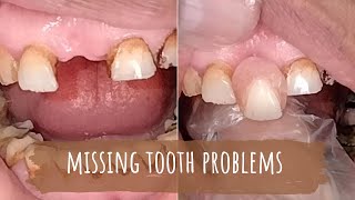 Front tooth replacement  missing tooth  removable tooth  partial tooth [upl. by Ulund345]