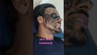 skin laser treatment mumbai besthairtransplant hairfall [upl. by Ysnap]