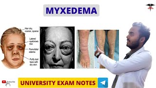 Myxedema  Hypothyroidism  Endocrine Physiology [upl. by Mell]