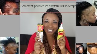 Comment FAIRE POUSSER les tempes degarnies [upl. by Arun]