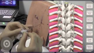 Needle Angulation for Thoracic Paravertebral Block TPVB [upl. by Manfred531]