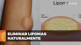 ✅ Remedios caseros para ELIMINAR lipomas o BOLITAS de GRASA  Salud180 🌿 [upl. by Morlee]