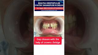 Teeth Gap closing With CAD CAM Crowns smilemakeover smile [upl. by Saber]