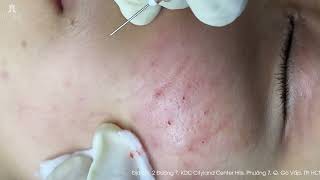 Big Cystic Acne Blackheads Extraction Blackheads amp Milia Whiteheads Removal Pimple Popping [upl. by Wickner915]