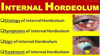 internal hordeolum [upl. by Litnahc521]