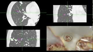 Virtual Bronchoscopy with navigation [upl. by Aurthur354]