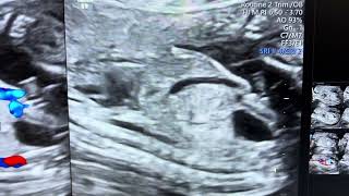 View of Ductus venosus  fetus in supine breech position [upl. by Atin]