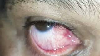 Episcleritis Ophthalmology clinical signs shorts [upl. by Waller640]