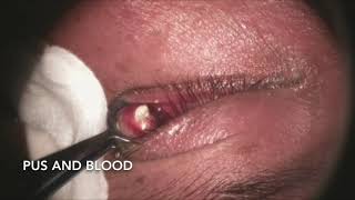 Incision and Drainage of Chalazion [upl. by Lanford]