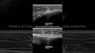 ultrasound Guided Interventions Healthy Images Pes Anserine [upl. by Quinta204]