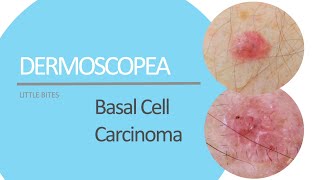 Dermoscopea Little Bites presents Basal Cell Carcinoma [upl. by Worsham]